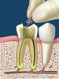 endodoncia en lima peru